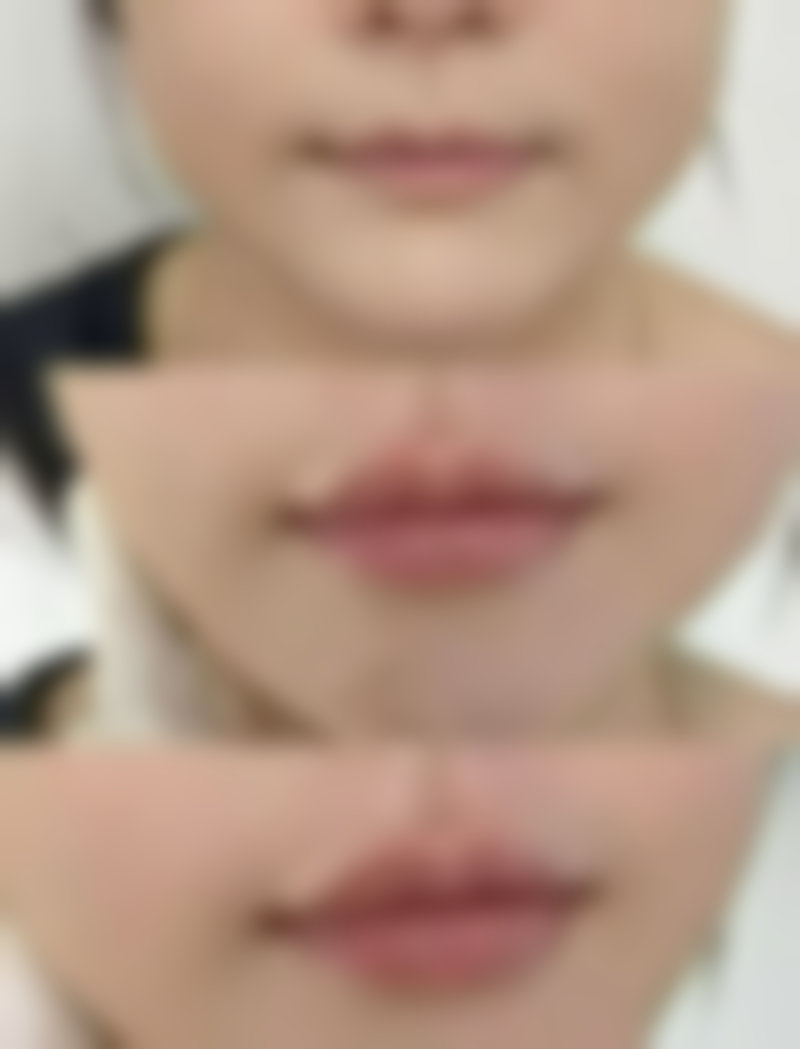 二、饮食与疤痕增生的关系