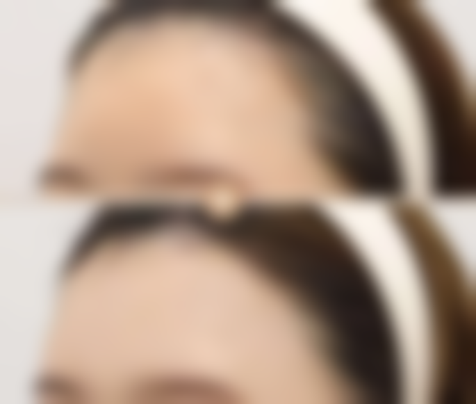 五、脸部擦伤后留下疤痕怎么淡化之激光治疗