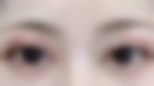 抽脂丰胸效果能维持多久？关键看脂肪存活率、术后护理与个人体质！ 