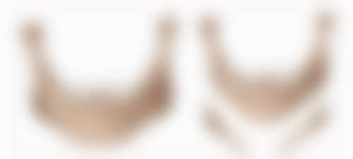 一、抽脂丰胸成效维持时间的大致范围