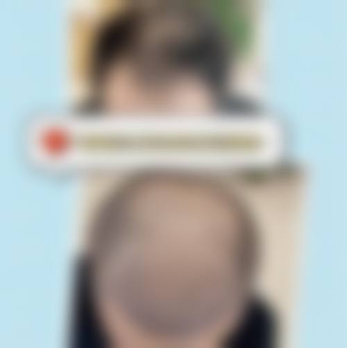 五、中山植德植发医院价格表