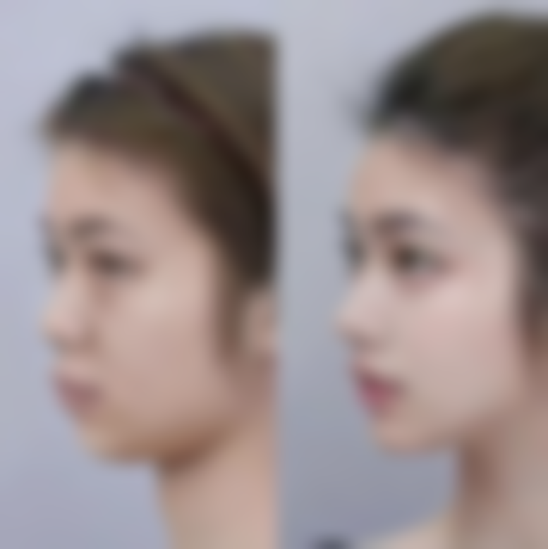 三、疤痕体质去旧疤的治疗注意事项