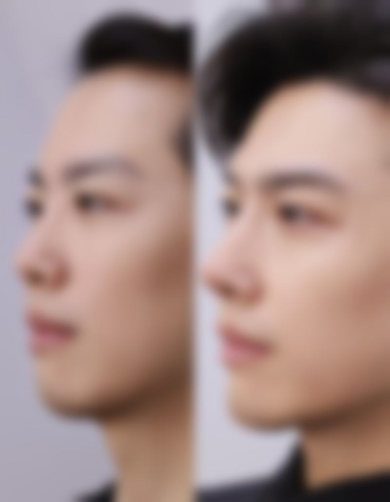 一、颈部疤痕的形成原因