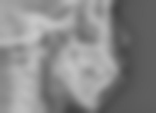 四、隆胸假体长期留存的影响