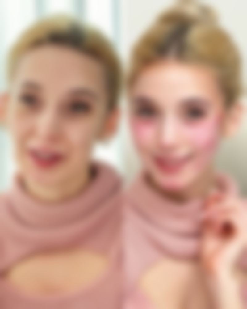 一、埋线双眼皮变窄的原因