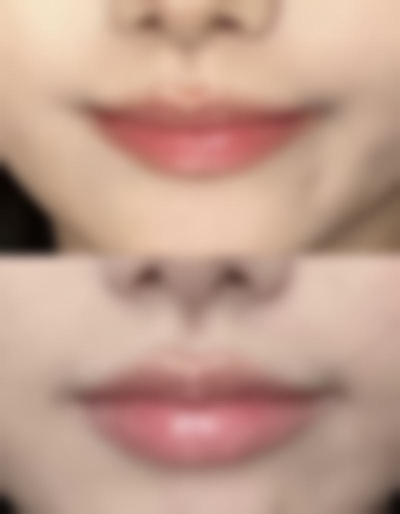 一、除皱针剂量的影响因素