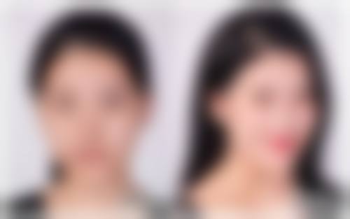 二、隆胸手术的风险及影响因素