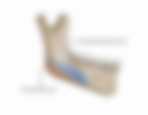 五、割双眼皮后的修复过程和心态调整