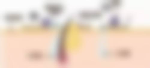 一、隆鼻头材料的选择原则