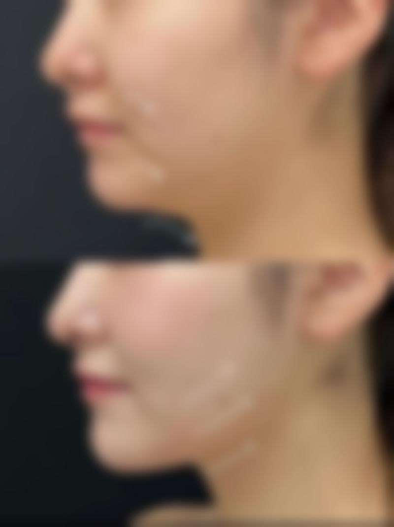 隆胸和抽脂哪个手术更危险些？手术方式、健康状况与医生技术影响风险程度 