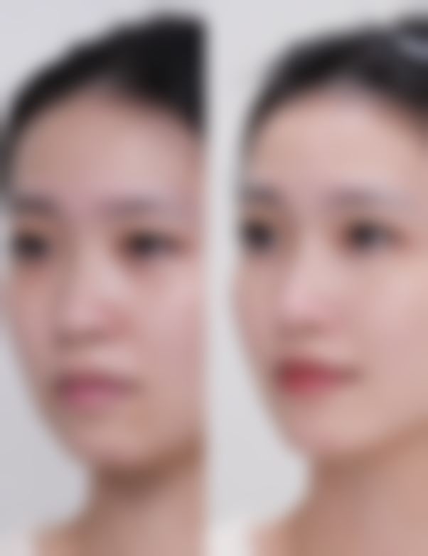 三、34岁做眼袋：手术方案的选择