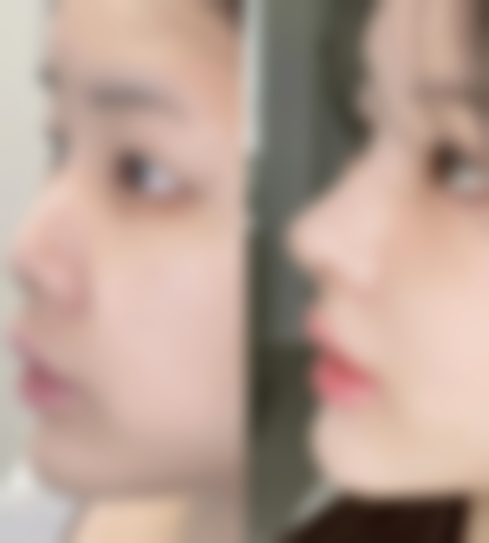 请问疤痕疙瘩刺痛有什么药物可以治疗