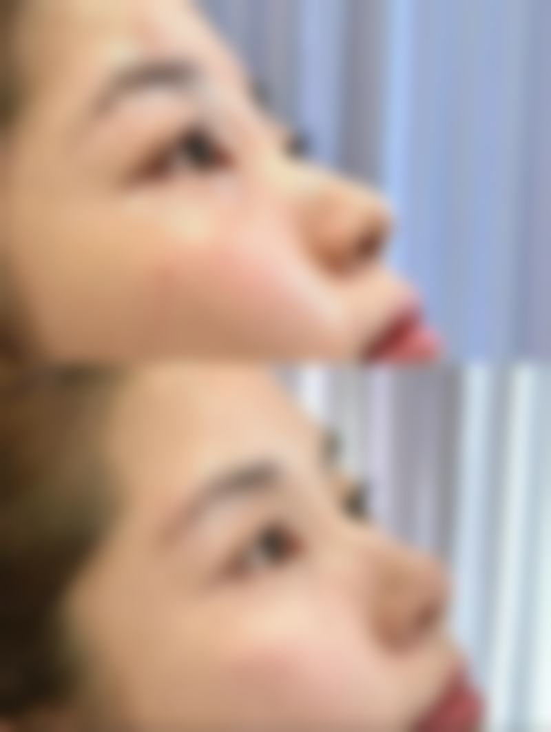 三、其他祛眼袋方案