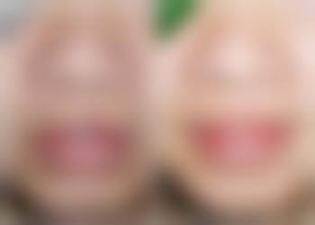 一、十三年的疤痕修复的总体原则