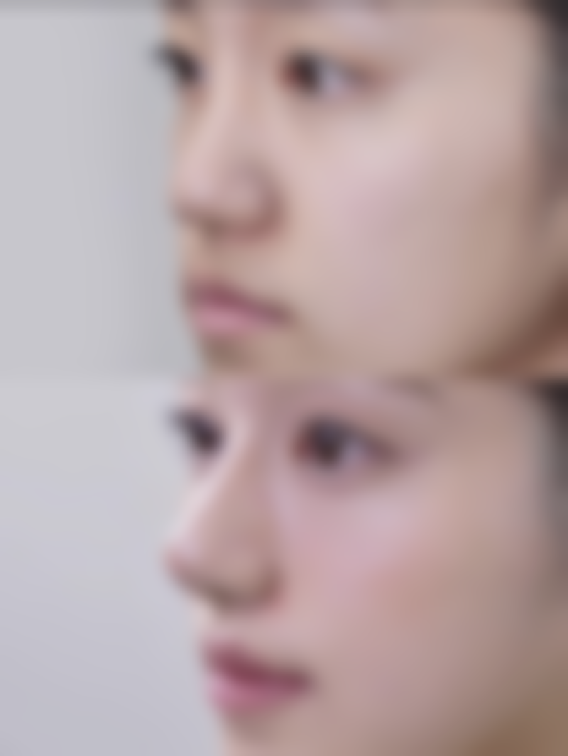 四、十三年疤痕修复的治疗周期和注意事项