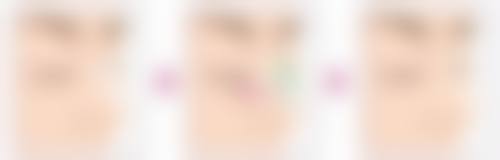 一、隆鼻消肿的一般时间节点