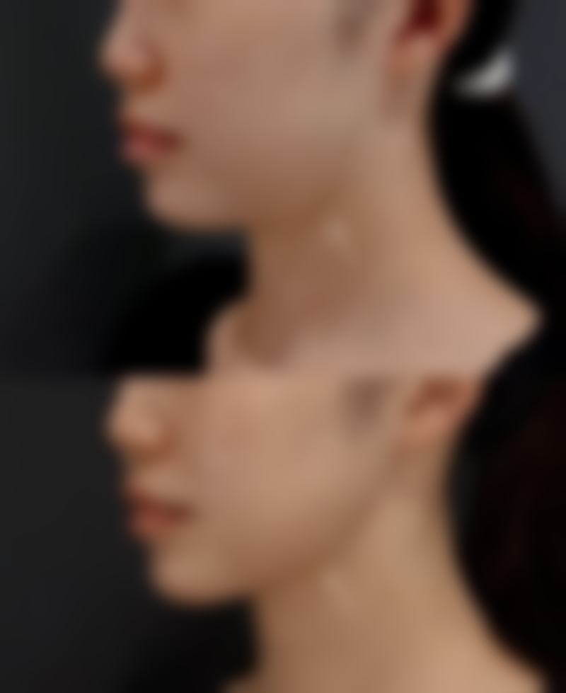 五、做安心隆胸手术安心吗？降低风险的关键要点