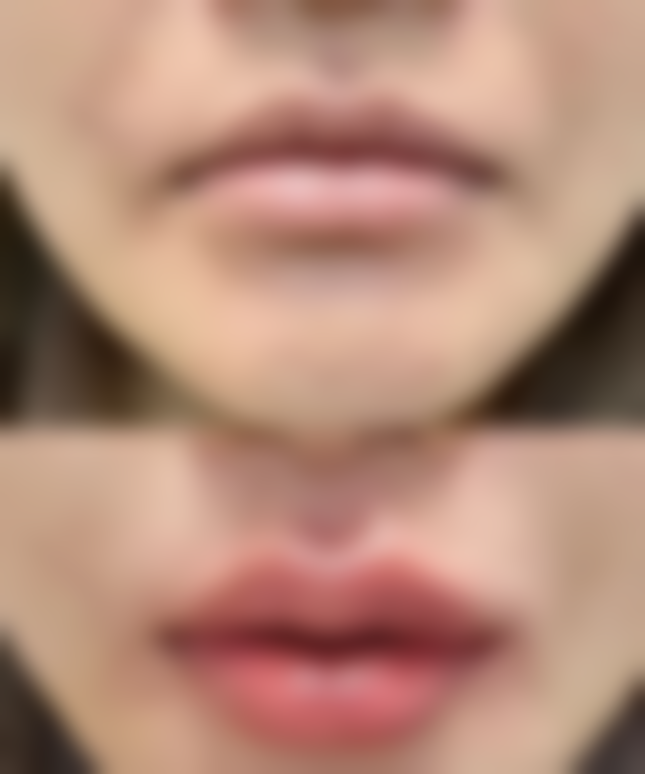 四、让拉双眼皮成效更持久的小妙招