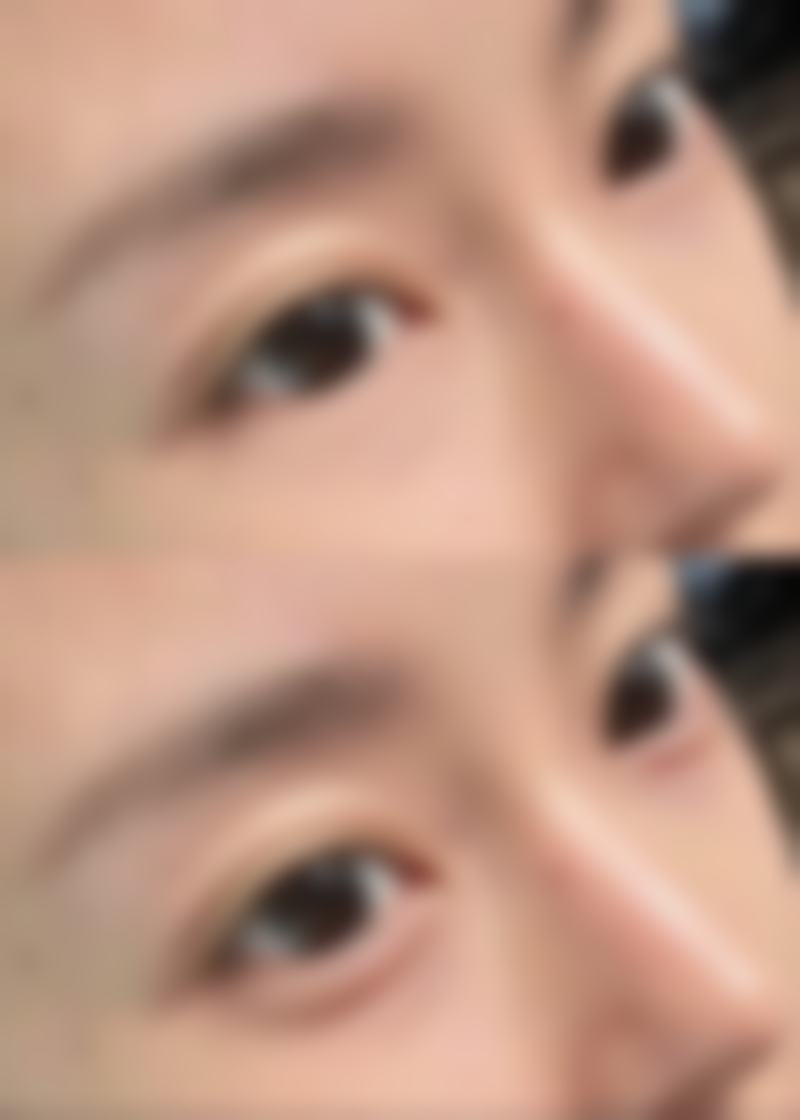 一、黑眼圈和眼袋的成因及类型判断