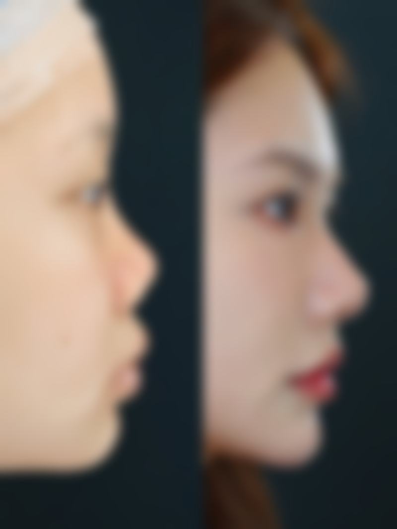 三、腿部吸脂的特殊副作用