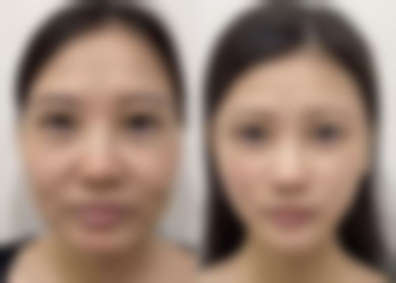 一、手臂和腿一起抽脂的可行性分析