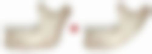 二、打瘦脸针能恒久保持吗？一次注射的成效维持时间