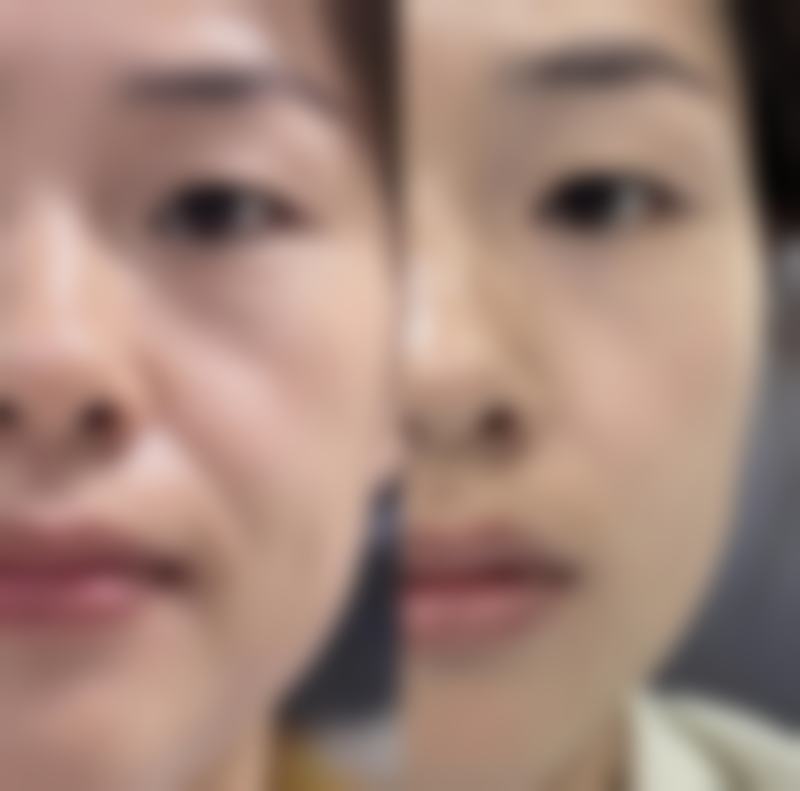 双眼皮术后上眼睑下垂怎么办？多种有效应对方法助你重拾明亮双眸