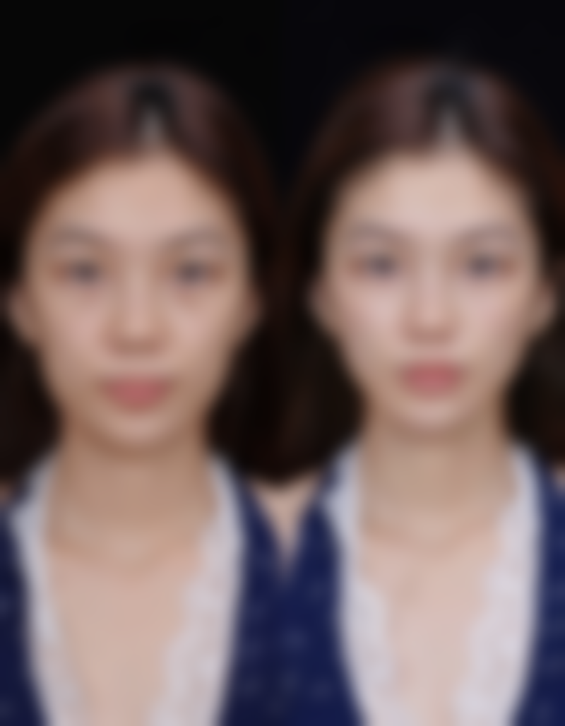 一、打完瘦脸针后脸部清洁的时间节点