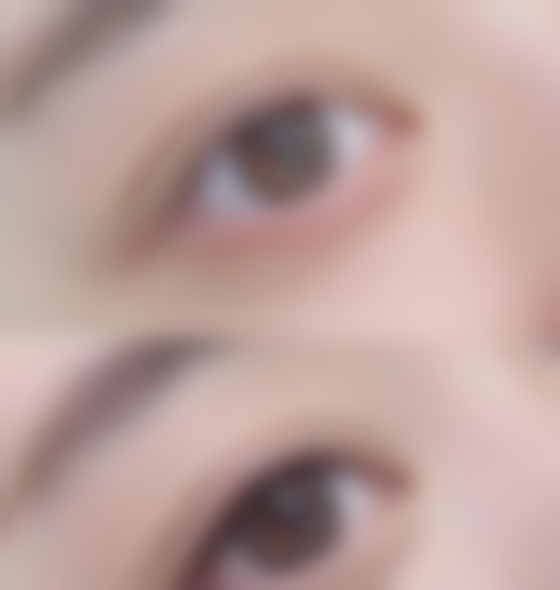 三、割双眼皮的风险与注意事项