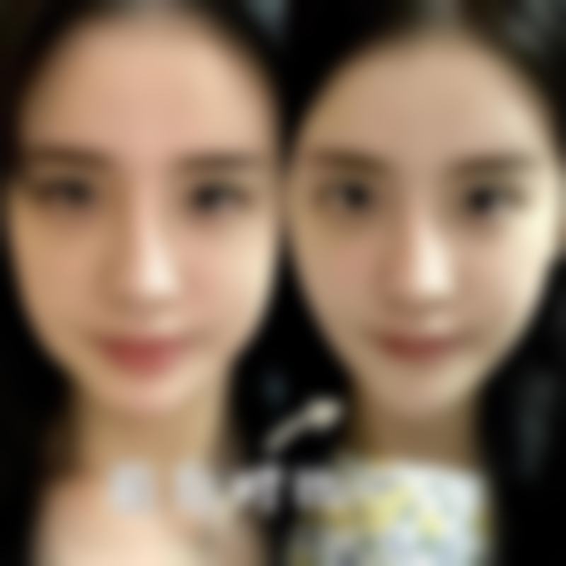 四、双眼皮鼻子拆线后碰水后的护理步骤