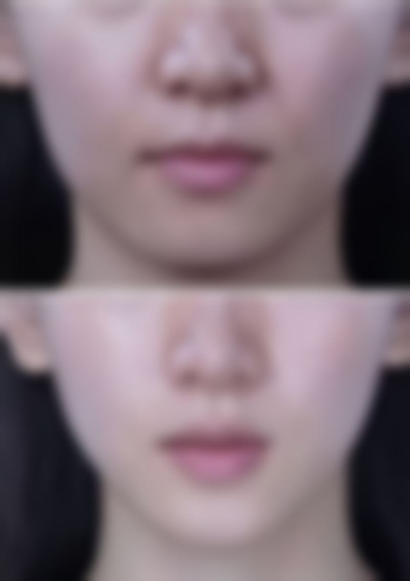 一单一双眼皮是什么基因？揭秘基因型差异、发育与环境对眼皮形态的影响