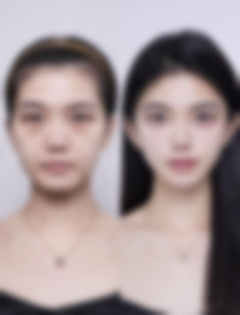 如何治疗油烫伤疤痕？多种方法助你有效去除油烫伤疤痕，重拾光滑肌肤！ 