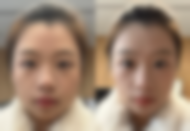 四、一单一双眼皮的总结