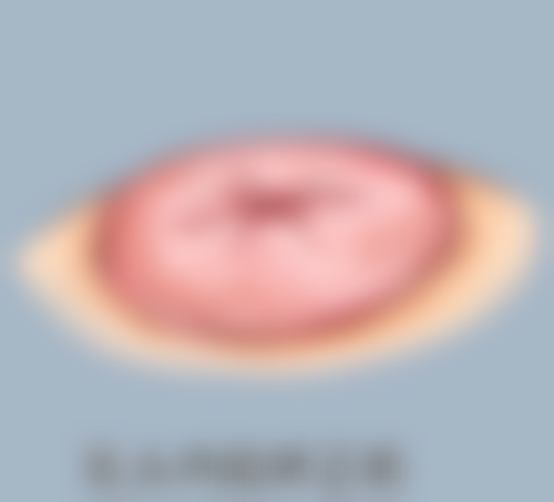 二、有没有做了假体隆胸取出的必要