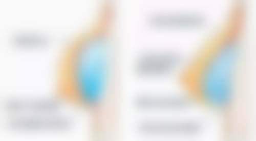 脂肪隆胸多久可以运动健身？不同阶段运动建议及注意事项全揭秘 