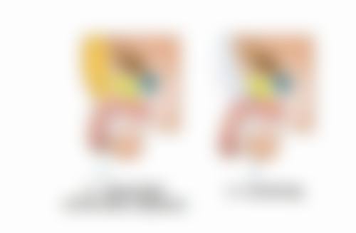 五、有没有做了假体隆胸取出的注意事项