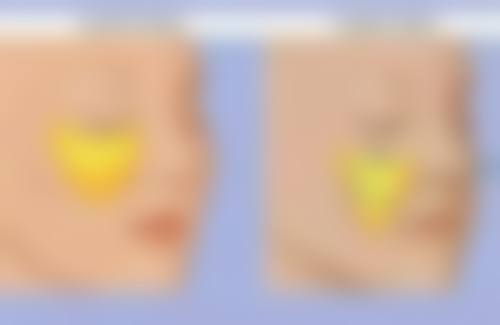 双眼皮埋线找不到线头了怎么办？别再担心啦