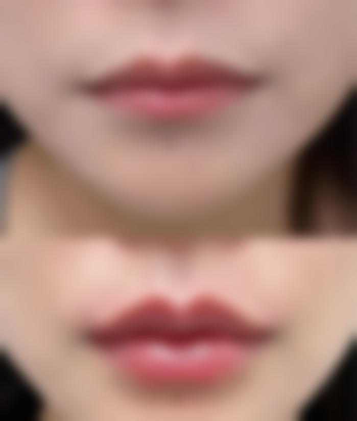 一、有没有做了假体隆胸取出的实例