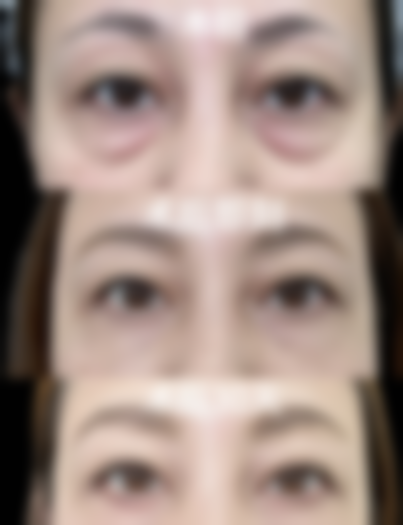 有没有做了假体隆胸取出的？女子隆胸24年后取出假体，术后恢复良好！ 