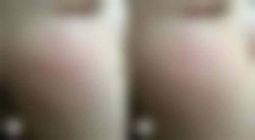 16岁可以抽脂吗？了解身体发育状况，谨慎对待医美，莫如住酒店般随意决定 