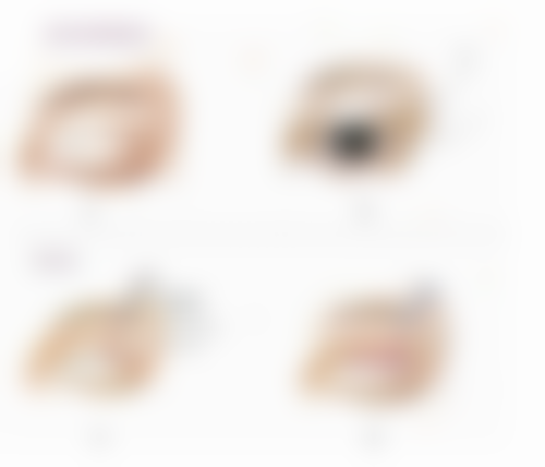 五、去除眼袋后下眼睑皱纹修复的影响因素