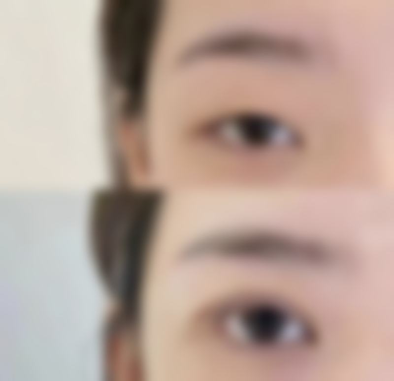 一、16岁为何不建议抽脂