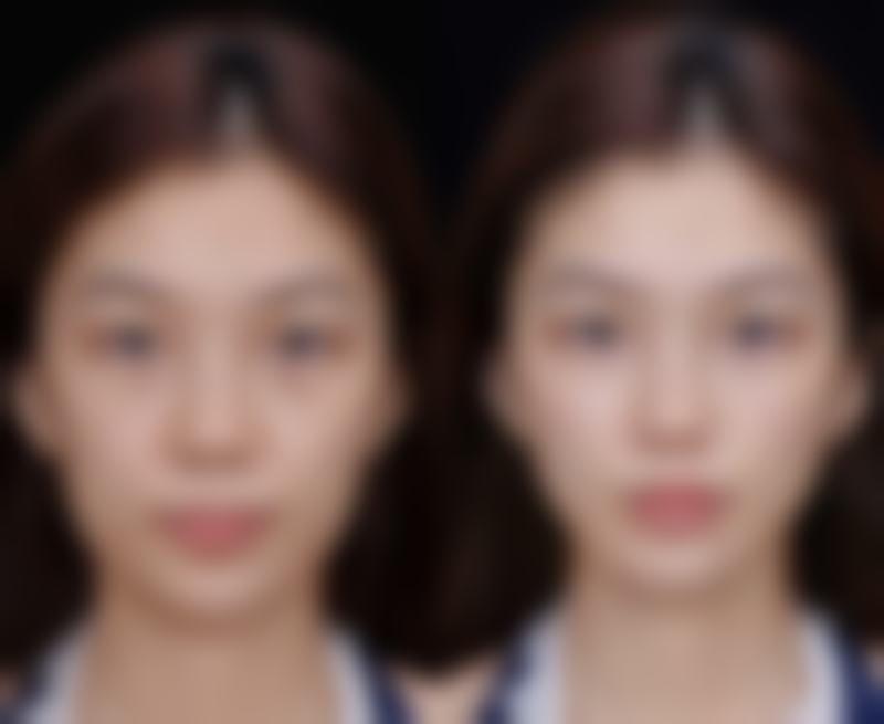 五、面部抽脂可以做吗？价格因素也得考虑