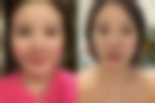 宝宝脸上疤痕会消除吗？了解影响因素与改善方法，附消除前后对比图片参考