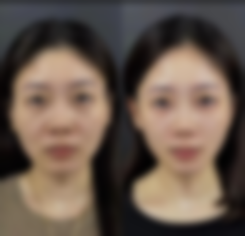 八、结尾：疤痕增生可以用艾灸吗？