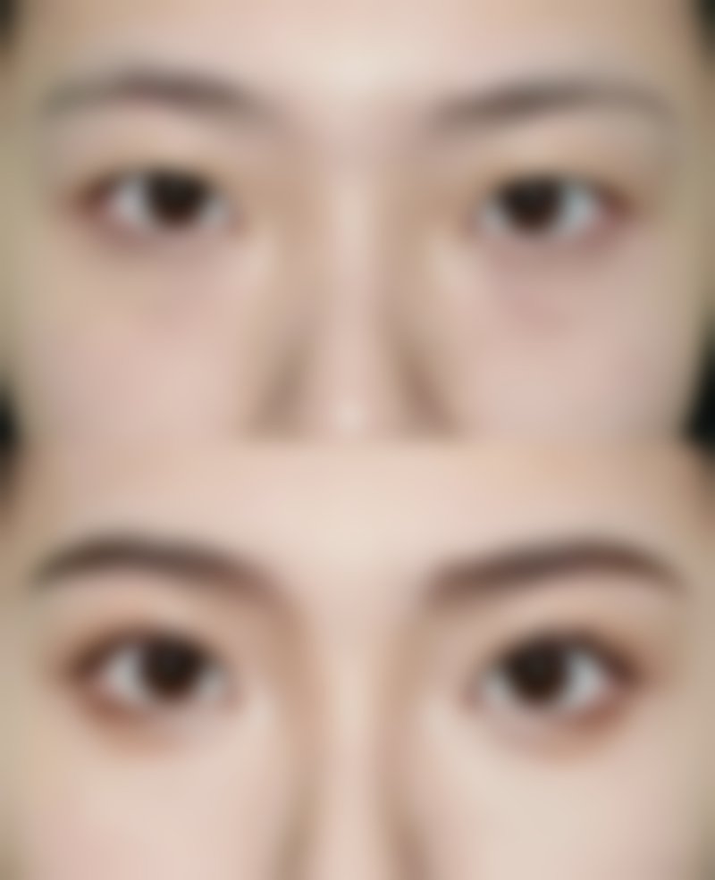 双眼皮第六天能拆线吗？了解影响因素、注意事项及恢复图片让你心中有数！ 