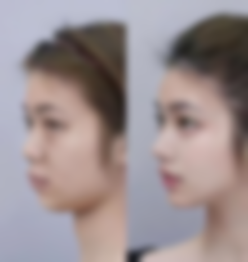 二、物理治疗去除旧疤痕