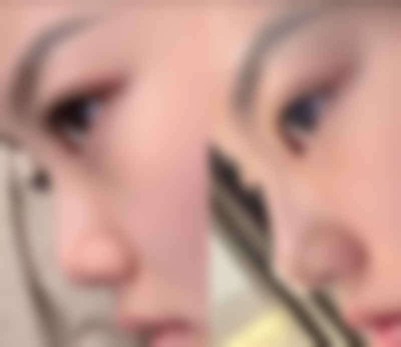 四、宝宝脸上疤痕消除前后对比图片参考