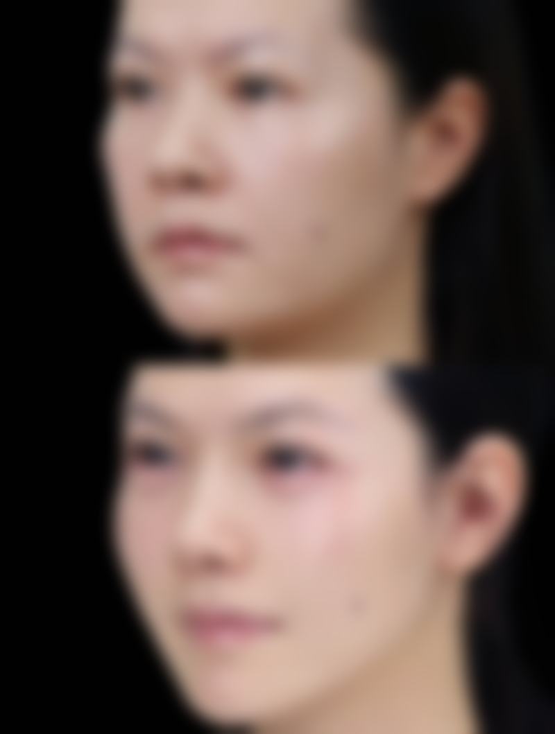 四、日常护理辅助去除旧疤痕