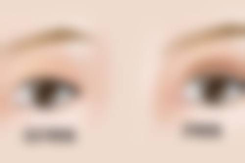 二、双眼皮增生多久可以好